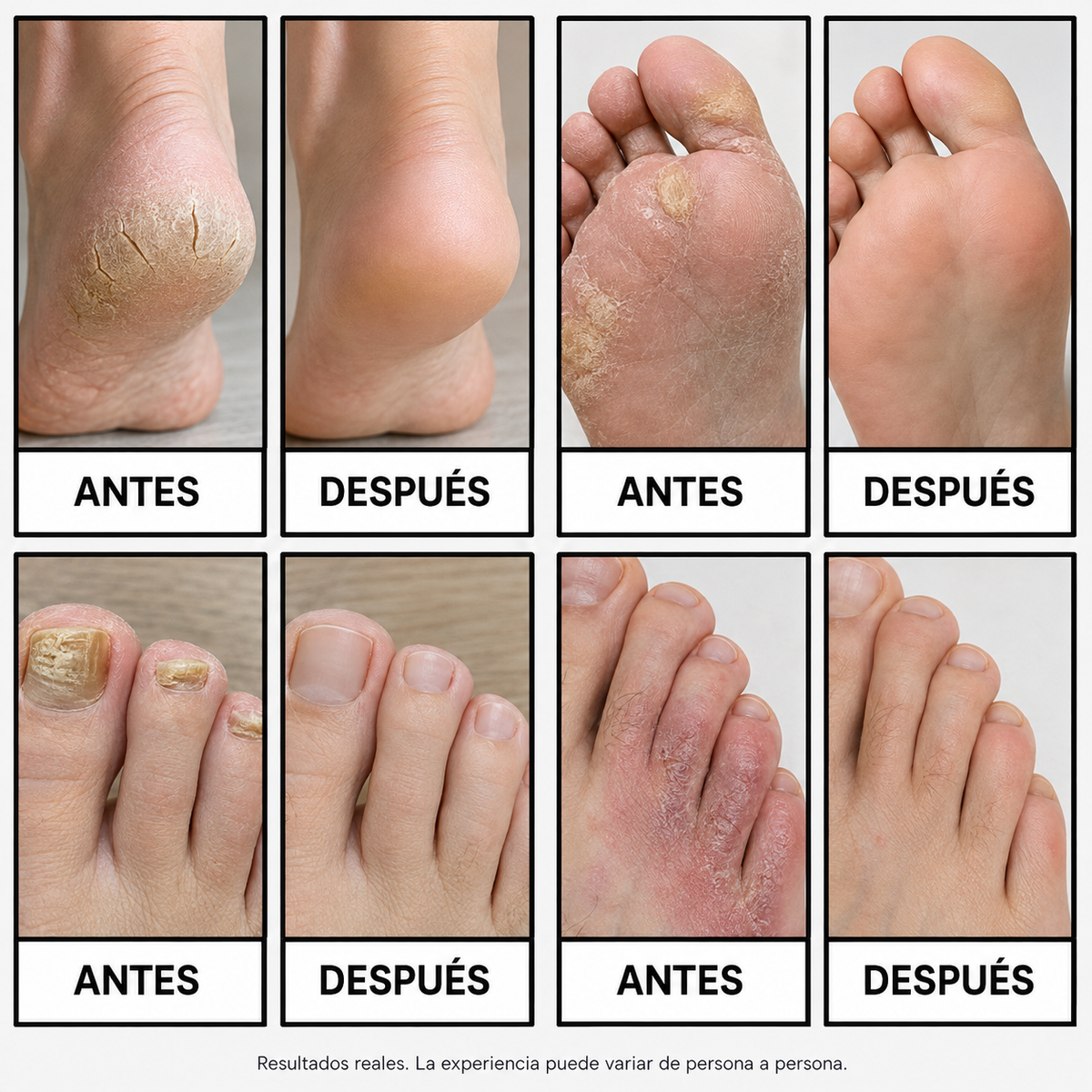 TerbiFin Spray 8% Anti-Hongos Pies Uñas